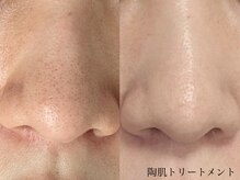 ムーンサン(Moon sun)/陶肌トリートメント