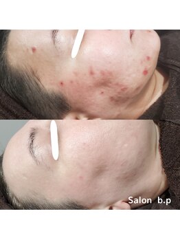 ビーピー 渋谷(b.p.)/ニキビケア ハーブピーリング