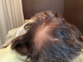 はる鍼灸整骨院/驚愕のダーマ鍼！　美髪鍼↓初回