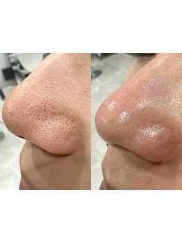 メンズフェイシャル