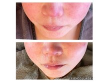 【結果重視】乾燥による肌の赤み改善！肌質改善肌育サロン