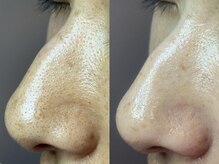 エミュ(emu)/毛穴キレイ♪