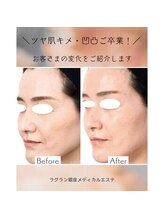 ラグラン銀座メディカルエステ 高輪ゲートウェイ店/ニキビ改善と脱毛の意外な関係