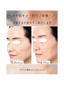 ラグラン銀座メディカルエステ 高輪ゲートウェイ店/ニキビ改善と脱毛の意外な関係