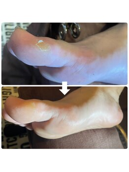 ビビィ(vivie)/タコ/ウオノメ、そのままですか?