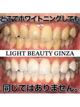ライトビューティー 銀座店(LightBeauty)/東銀座　ホワイトニング症例写真