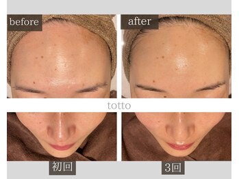 サロントット(salon totto)/before→after　小じわケア