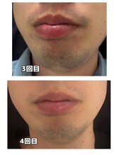 ダンニヒル(dannihil)/【ヒゲ脱毛】20代会社員4回目