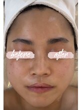 ミピマム 恵比寿店(Mipimam)/20代女性半顔変化写真