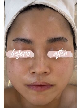 ミピマム 恵比寿店(Mipimam)/20代女性半顔変化写真