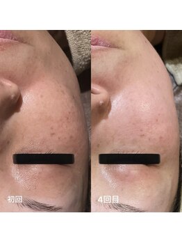 オリス(Oris)/グリーンピールbefore/after