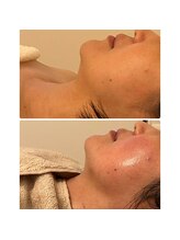 ルミア(LUMIA)/小顔造形ロイヤルコース３回目