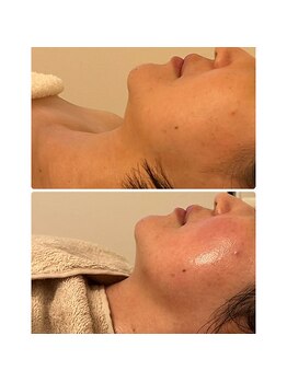 ルミア(LUMIA)/小顔造形ロイヤルコース３回目