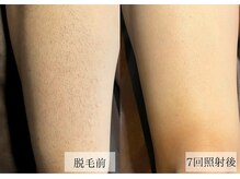 メンズアルファ/【脚】光脱毛before after 40代