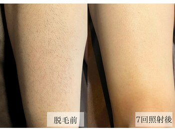 メンズアルファ/【脚】光脱毛before after 40代