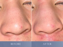 カズキ ハギワラ(Kazuki Hagiwara)/毛穴ケア施術当日ビフォアフ