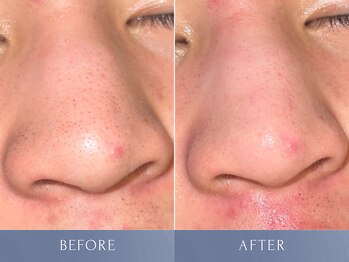 カズキ ハギワラ(Kazuki Hagiwara)/毛穴ケア施術当日ビフォアフ