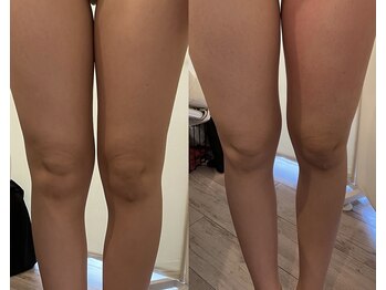 ベリーベリー 九条店(VERY-VERY)/ボディRFで痩身効果