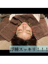 ルディア 堂島店(ledia)/美容鍼でむくみスッキリ