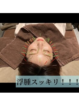 ルディア 堂島店(ledia)/大阪美容鍼でむくみスッキリ