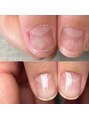 エトワ(etoi) 【自爪育成】1度でも爪周りの皮膚の状態やピンクの部分伸びます