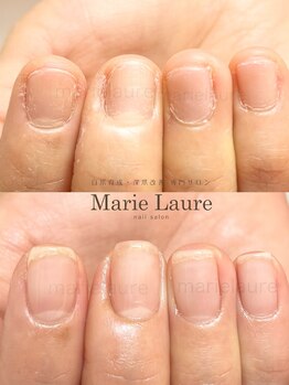 マリーロール 淀屋橋本店(Marie Laure)/自爪育成/深爪矯正/ネイルケア