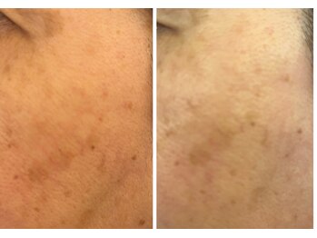 アイビー(aibe:)/1回の変化