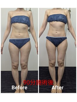 フィニシオン/40代90分施術　立ち仕事浮腫歪み