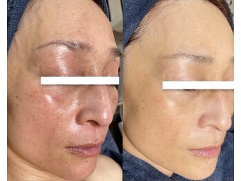 ムーンリズム(Moonlism)/【TIPハーブ症例】赤み・敏感