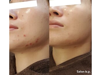 ビーピー 渋谷(b.p.)/ニキビケア ハーブピーリング