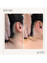 スプランドゥール(Splendeur)/うなじ　ワックス脱毛＆光脱毛