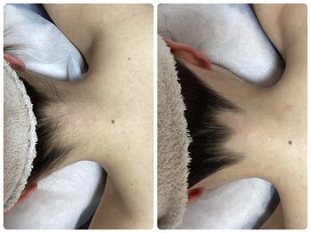 ルルトウキョウ 池袋店(LULU.tokyo)/うなじ脱毛