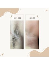 ヴィーキュア 渋谷店(Ve-cure.)/脇ダブル脱毛