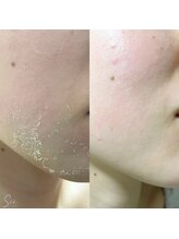 ラウーム 下北沢(lawomb)/ハーブピーリング Before/After