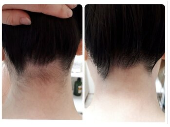 カヌヌ(kanunu)/部分脱毛/うなじ・背中