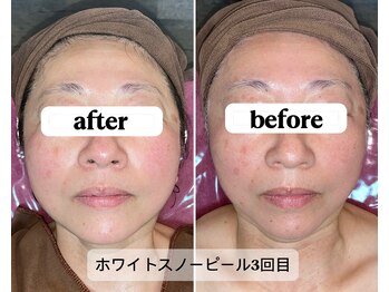 エレナ(Elena)/【before＆after】スノーピール