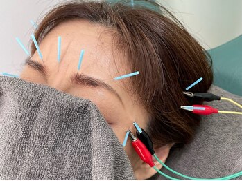たまプラーザ駅前鍼灸整骨院の写真/美容鍼・鍼のセットコースご用意♪24時まで営業&駅近で通いやすい◎1人1人のお客様の不調と向き合います◎