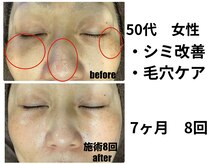 ビープラス(Biplus)/【50代お悩み】シミ・毛穴改善　