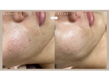 ネリネ(Nerine)/ハーブピーリング3回の効果