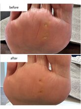 ケアプラス(care plus)/足裏角質ケア