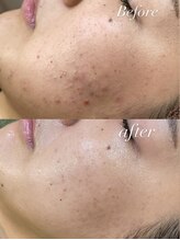 レシェルサロン(Lechelle Salon)/ハーブピーリング＋ダーマエステ