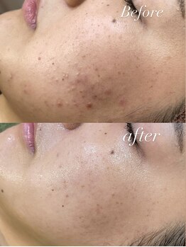 レシェルサロン(Lechelle Salon)/ハーブピーリング+ダーマエステ