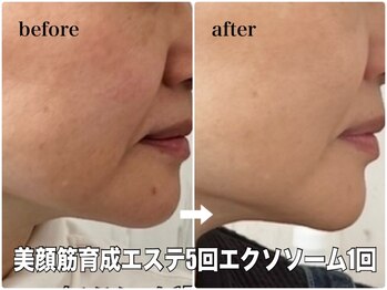 リエル(RIEL)/小顔矯正×美顔筋育成エステ