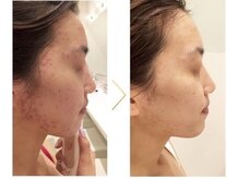 パルティール 恵比寿店(partir)/赤紫のニキビもこの通り！