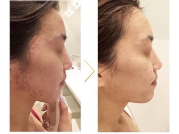 パルティール 恵比寿店(partir)/赤紫のニキビもこの通り！