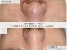 ラヴィオーラ 梅田店(La Viora)の雰囲気（ダイヤモンドハーブピーリング［ニキビケア/毛穴ケア/シミケア］）