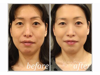 アン グレーヌ 自由が丘(unegraine)/引き締め&頬はふっくら持上がる