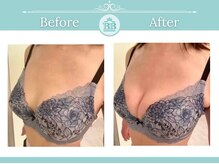 美人バスト 千早店/バストアップ◇育乳症例◇