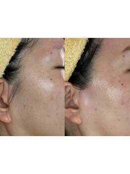 顔脱毛がしたい