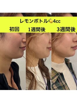 ララチッタ(L'la citta)/レモンボトル4cc